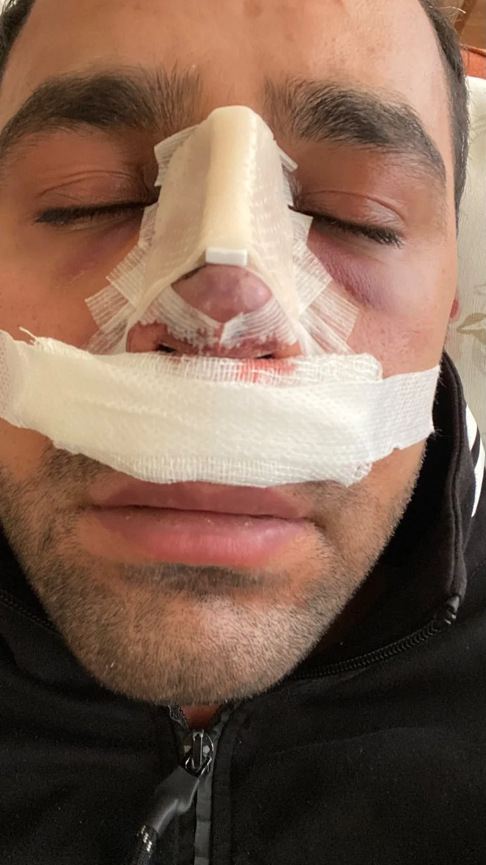 Estetik ameliyat sonrası yüzünde iz kalan hasta hastaneye dava açtı