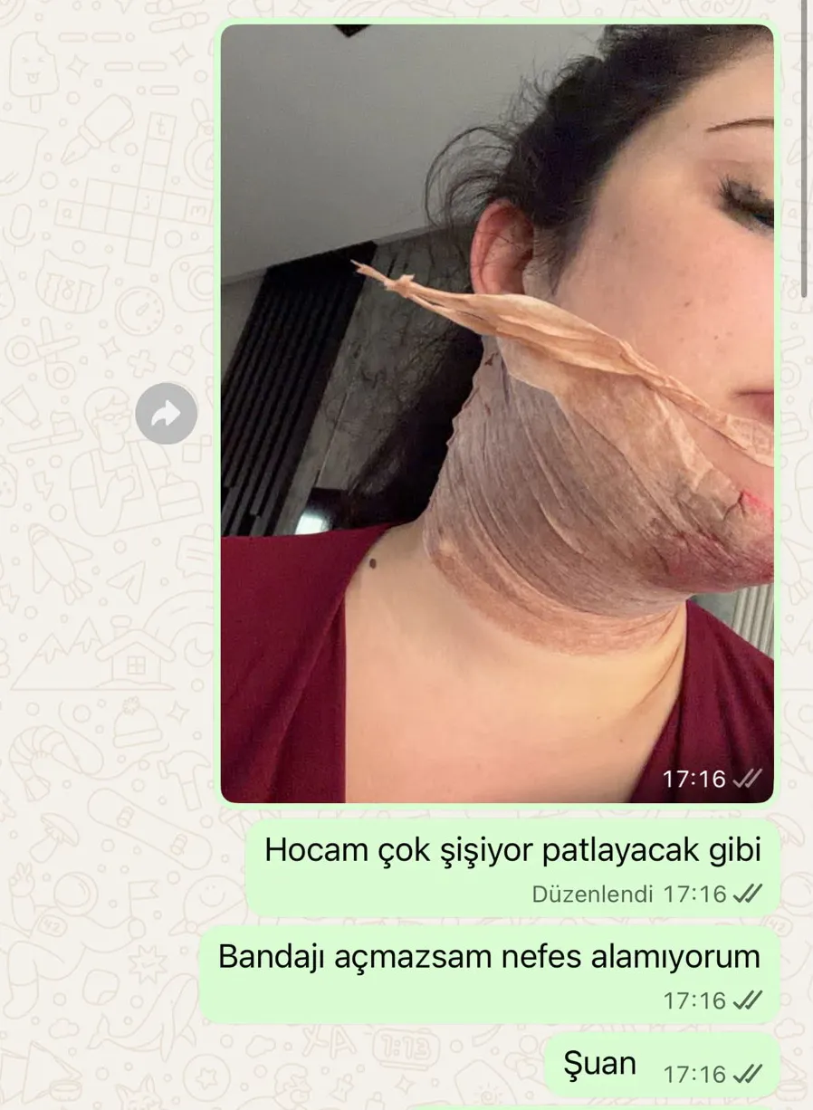 Güzelleşmek isterken ölümden döndü: Estetik operasyon sonrası kabus dolu günler
