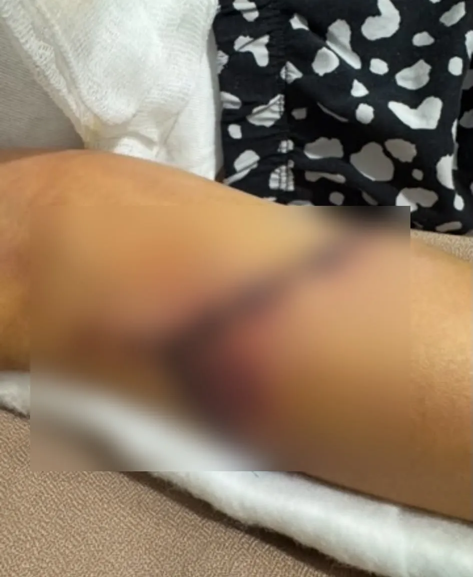 Okul koridorunda korkunç kaza: 12 yaşındaki öğrencinin koluna kapı kolu saplandı